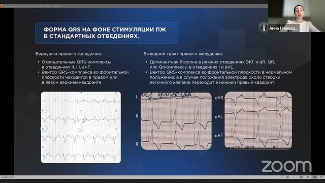 Основы электрокардиостимуляции на ЭКГ смотреть онлайн