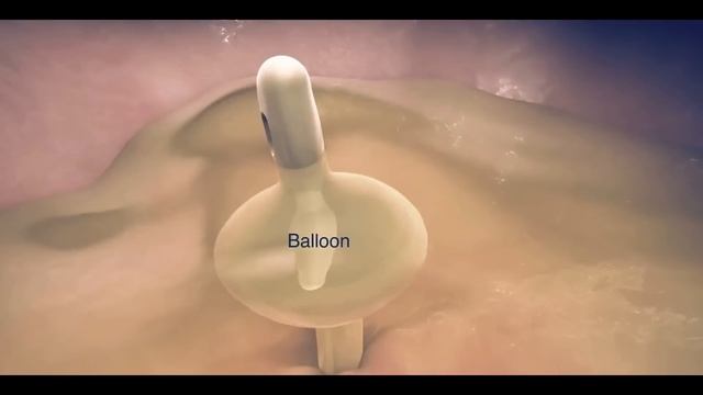 Foley Catheter insertion and purpose | Animation | смотреть онлайн