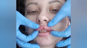 Удаление филлера из губ