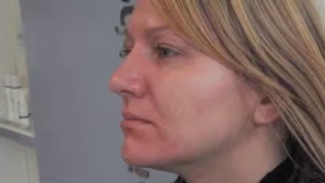 How I got rid of acne using Lustre Pure Light смотреть онлайн