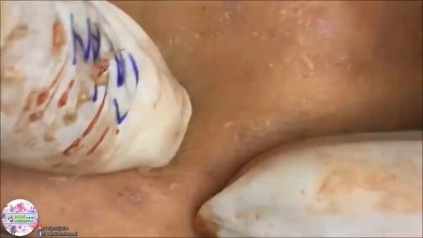 БОЛЬШИЕ УГРИ ПРЫЩИ НА ЛИЦЕ! ДАВЛЮ Как избавиться от прыщей!