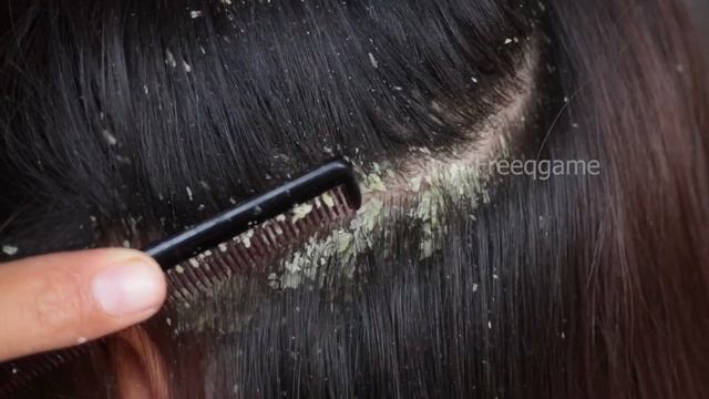 Combing Big Dandruff Flakes!!!  Dandruff Scratching Satisfying #672