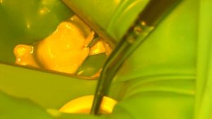 Лечение кариеса 1.6 класс 1 по Блэку с использованием системы диагностики кариеса Soprolife