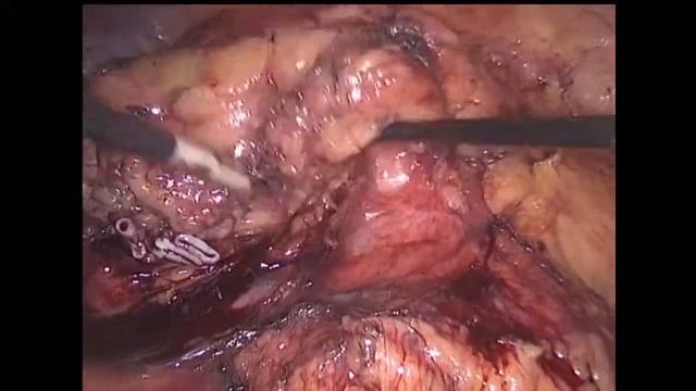 Laparoscopic Left Nephrectomy / Лапароскопическая Нефрэктомия слева смотреть онлайн