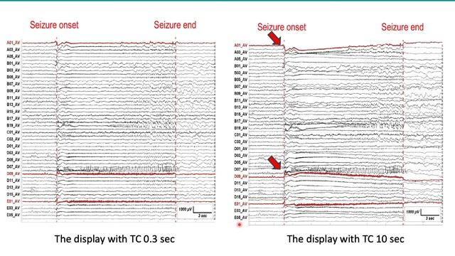 Ictal direct current shifts contribute to defining the core ictal focus in epilepsy surgery смотреть онлайн