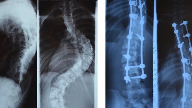 Хирургическое лечение сколиоза 4 степени | Отзывы пациентов смотреть онлайн