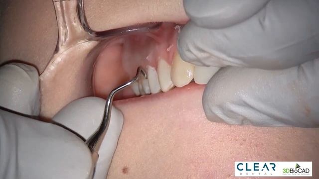 Изготовление mock-up, оценка полученного результата, удаление mock-up смотреть онлайн