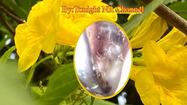 Biggest Ear Wax Removal || Ear Wax Removal At Home