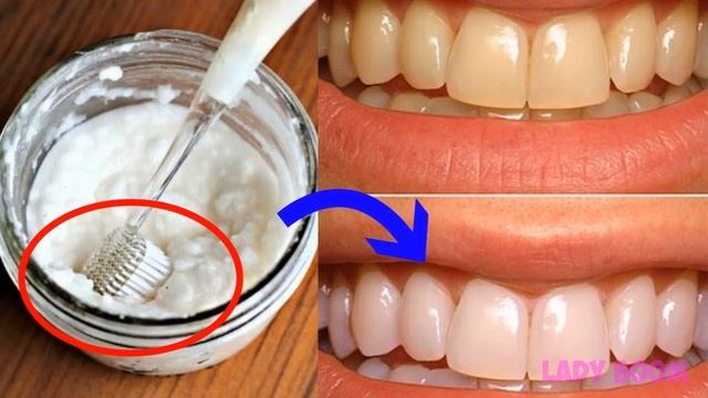 Как Можно Отбелить Зубы Дома за 3 дня и Удалить зубной камень не обращаясь к стоматологу Желтые зубы смотреть онлайн