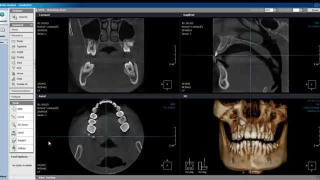 adding implant to xelis library смотреть онлайн