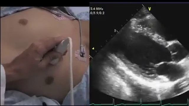 Echocardiography How to Find a Window.mov смотреть онлайн