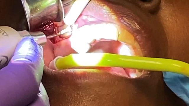 Smile Shop Dental: Lateral Sinus Augmentation to Prepare for Dental Implant смотреть онлайн