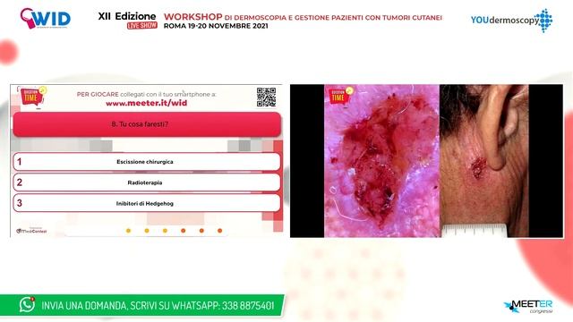 XII Workshop - G. Brancaccio - Carcinoma basocellulare: opzioni terapeutiche смотреть онлайн