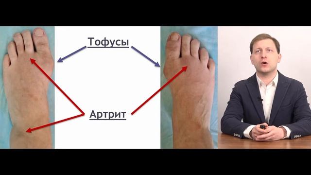 Коморбидный пациент с подагрой: возможности уратснижающей терапии. смотреть онлайн