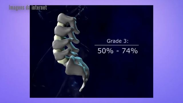 VT Espondilolistese - Dr. Marcelo Perocco смотреть онлайн