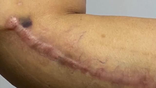 DISGRACED Miami plastic surgeon, Dr Adam J Rubinstein, Butcher surgeon, Complications, Poor skills смотреть онлайн