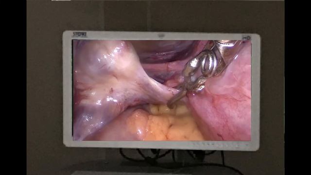 Клуб для любителей лапароскопии в гинекологии смотреть онлайн