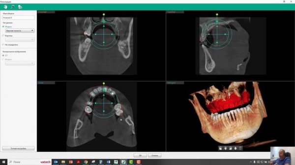 Объединение КТ и STL в программе Ez3D-i