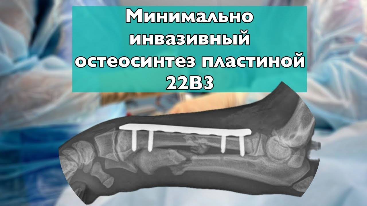 Minimally Invasive Plate Osteosynthesis (MIPO) In Dog (4K)
