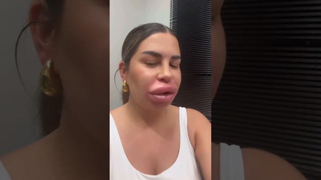 Звезда «Дома-2» Майя Донцова удалила филлер из губ, ошарашив опухшим лицом смотреть онлайн