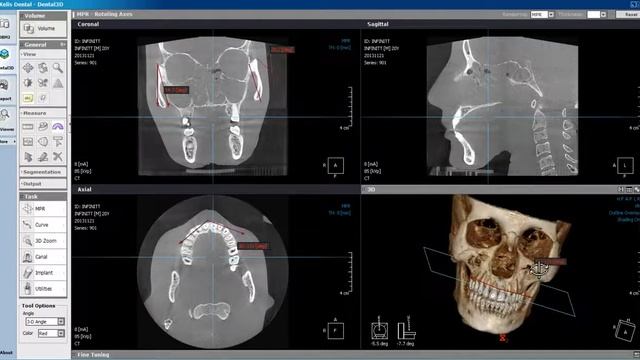 Xelis Dental Measurement Tools
