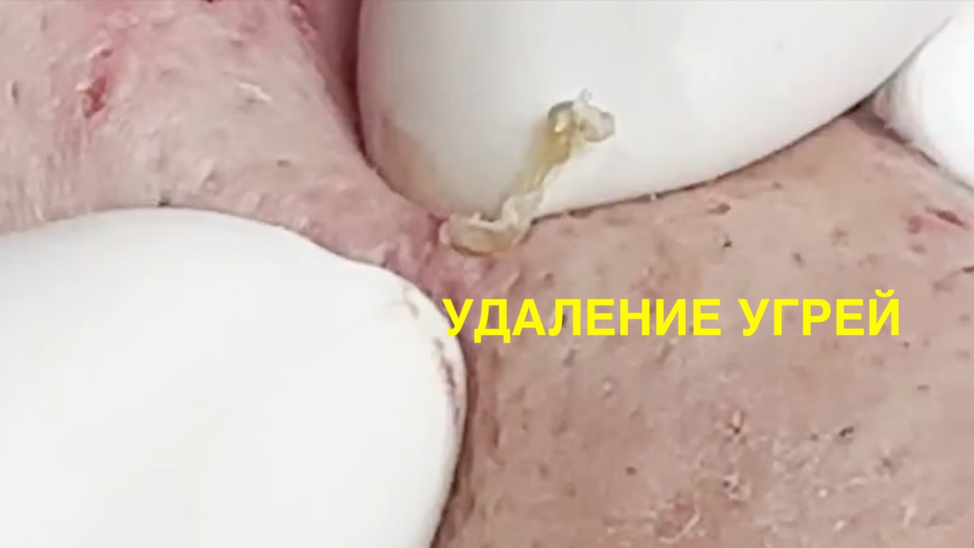 УДАЛЕНИЕ УГРЕЙ ЖИРОВИКОВ. ЧИСТКА КОЖИ.