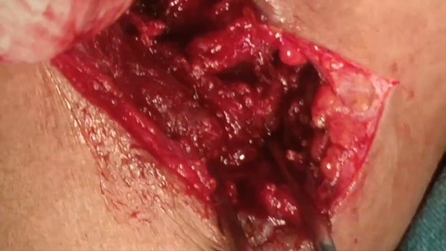 Open window thoracostomy or Pleurocutaneous window Dr. Ravindra Kumar Dewan смотреть онлайн