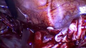 Лапароскопическое удаление кистомы с сохранением яичника.