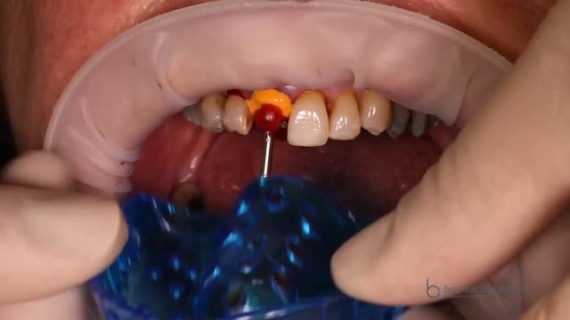 Tooth Extraction And Immediate Implant Placement смотреть онлайн