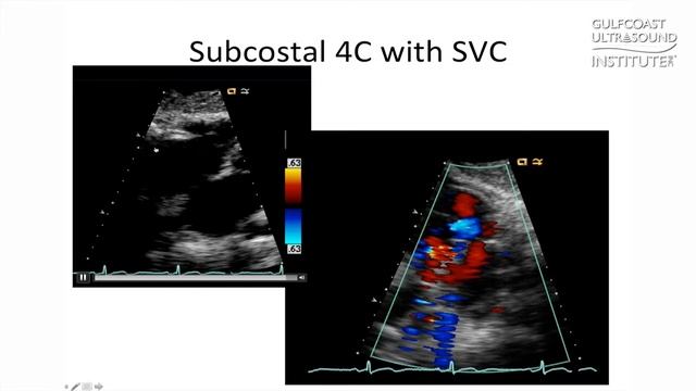 Hot Tip-How to View SVC Flow in a Subcostal Window to Rule Out a PFO смотреть онлайн