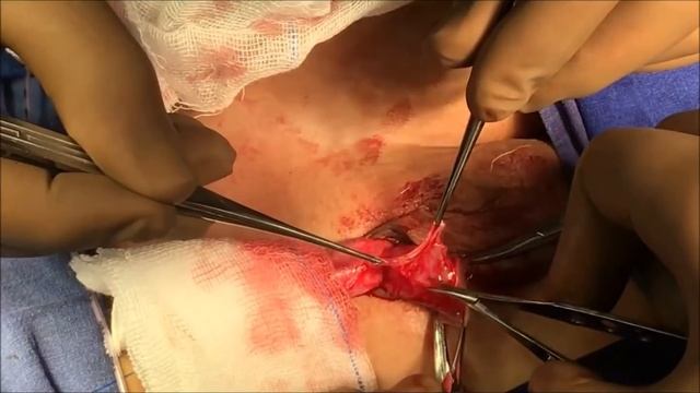 Hypospadias Repair: Real Time, Unedited смотреть онлайн