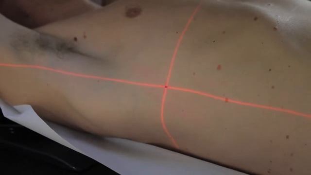 Traitement par radiothérapie (pratique) - Oncogard à l'Institut de Cancérologie du Gard (ICG) смотреть онлайн