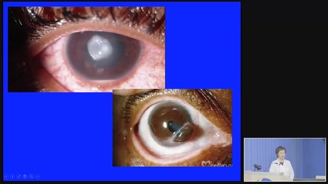 Кератиты. Бактериальные.Часть3 смотреть онлайн