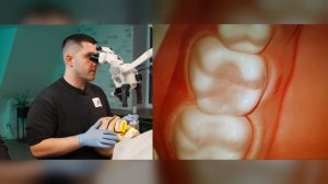 Реставрация зуба 3.6/4.6 - Руслан Беретарь | RestArt #zumax #kerr #stommarket #stomshop