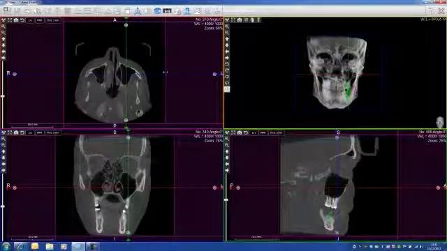 How to use a Cone Beam like WhiteFox or Trium for a sinus lift surgery made by Acteon Imaging Suite смотреть онлайн