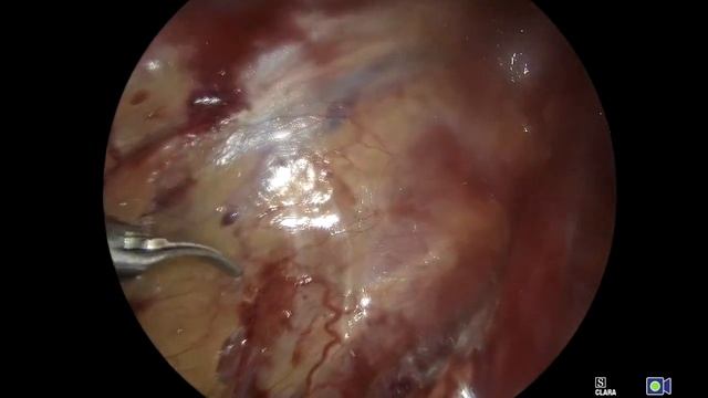 Лапароскопическая герниопластика (ТАРР) со звуком. смотреть онлайн