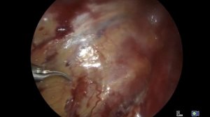 Лапароскопическая герниопластика (ТАРР) со звуком.