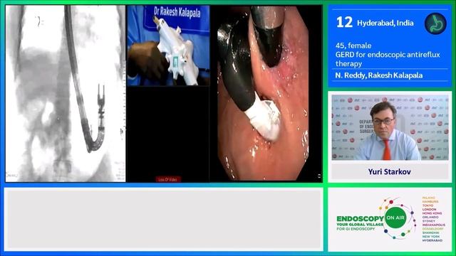 EOA 2020 Case 10 Endoscopic antireflux procedure Reddy, Kalapala смотреть онлайн