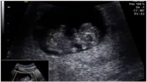 УЗИ на 10 неделе беременности