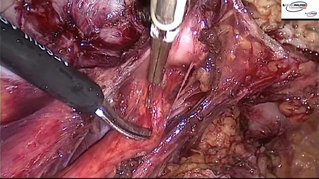 LAPAROSCOPIC RESECTION OF PARAMETRIAL ENDOMETRIOSIC NODE.MALZONI смотреть онлайн