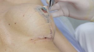 Уход за рубцами. Часть 3