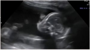 УЗИ на 20 неделе беременности