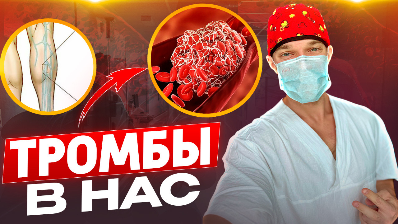 ТРОМБЫ в наших сосудах, варикоз, бляшки и тромбозы. смотреть онлайн