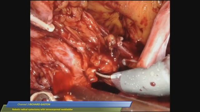 Richard Gaston - Robotic Radical Cystectomy with Intracorporeal NeoBladder смотреть онлайн