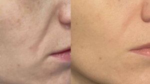 Буккальный самомассаж. Основные движения.