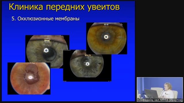 Алгоритм диагностики увеитов. Долабораторная диагностика смотреть онлайн