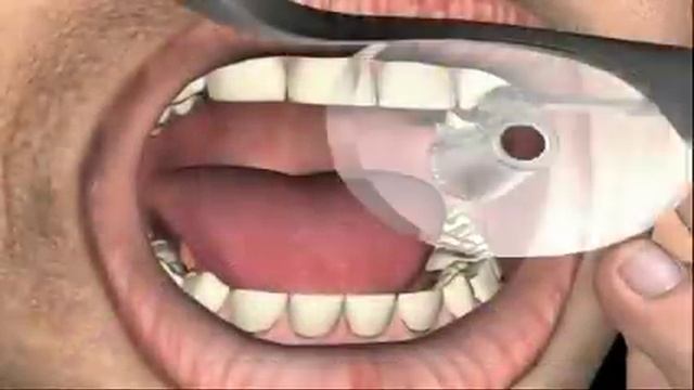 Root Canal Treatment смотреть онлайн