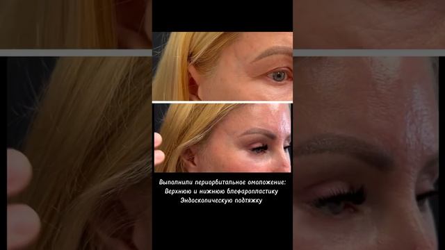 Выполнена #блефаропластика и #эндоскопическаяподтяжка