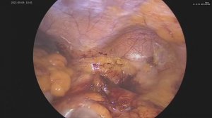 Поясничная грыжа лапароскопическое удаление