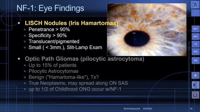 MedPix Video - The Phakomatoses: von Recklinghausen Neurofibromatosis (NF1) смотреть онлайн